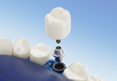 Dantų implantacija