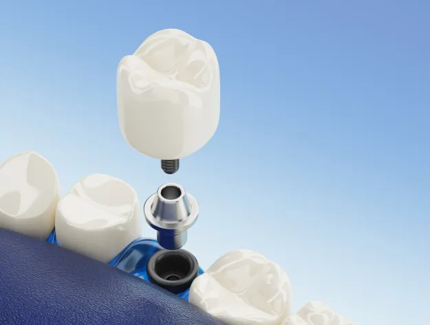 Dantų implantacija